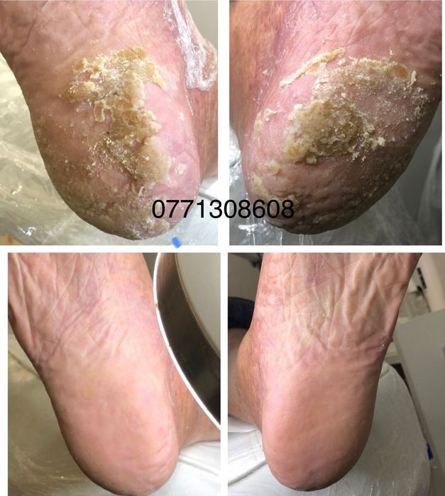 Pedichiura medicala.Instrumentar sterilizat in autoclav.Liftup gel