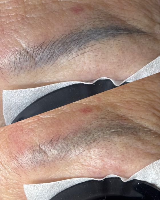 Лазерное удаление татуажа