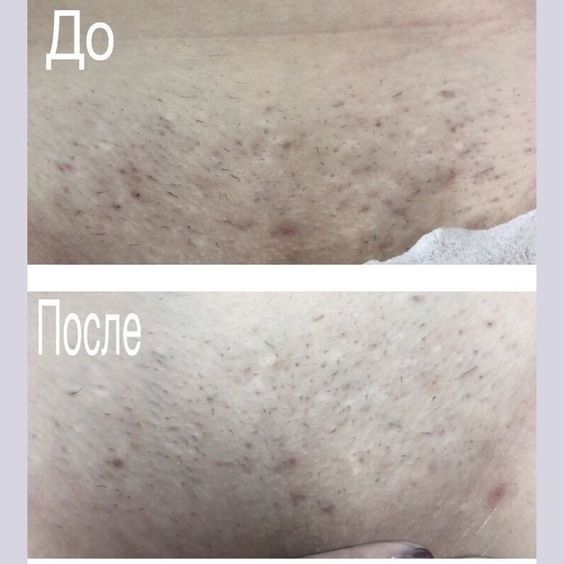 Обучение лазерной эпиляции