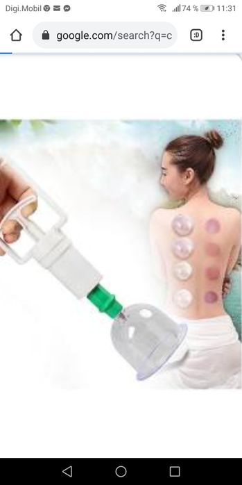 Terapie cu ventuze. Cupping terapie.