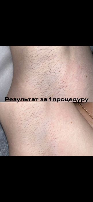 Лазерная Эпиляция в Самарканде -50% скидка на первое посещение!