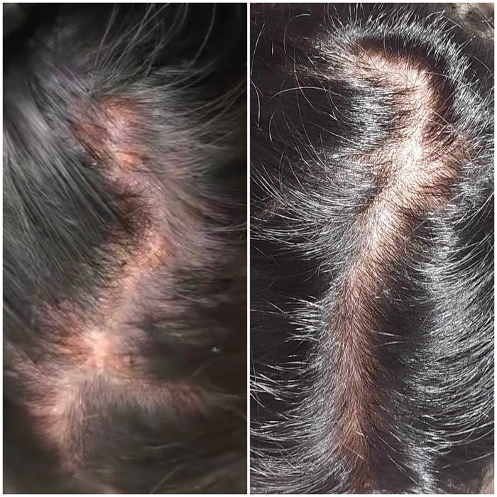 Мехлем против Гъбички по кожата / Дерматит / Екземи