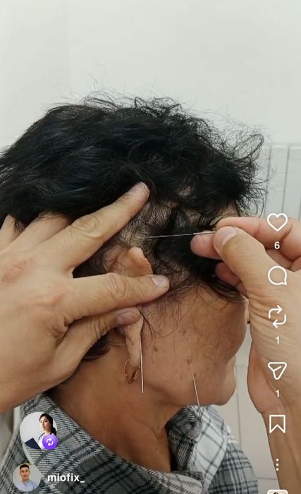 Массаж хиджама иглотерапия