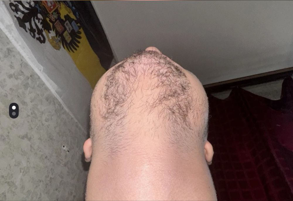 Soch va soqol o'stiradigan losyon