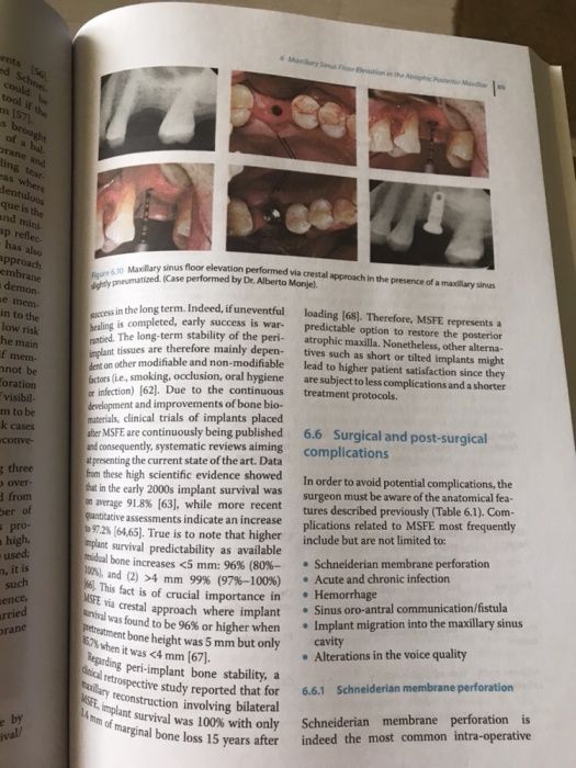 Platelet Rich Fibrin in Regenerative Dentistry 2017