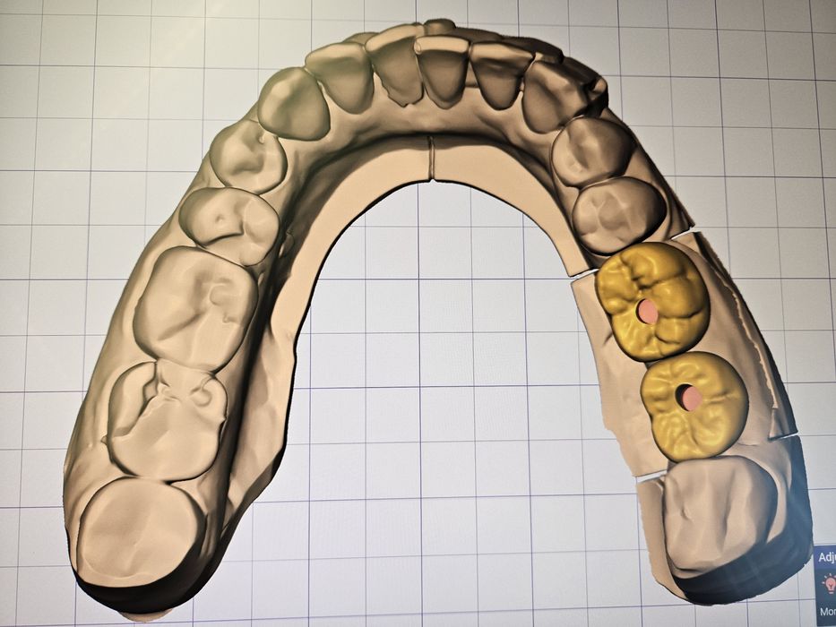 Дигитален Дизайн на Зъбопротезни конструкции от Зъботехник чрез Exocad