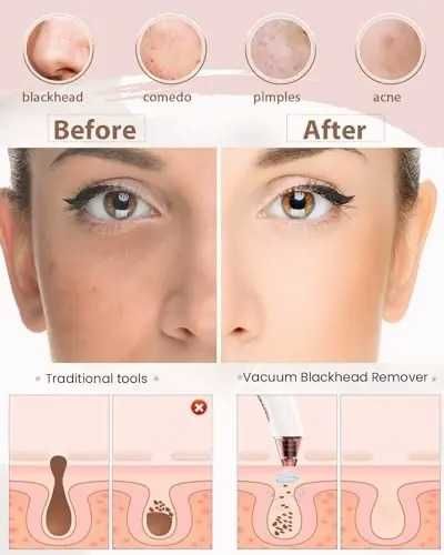 Топ цена! Нов вакуум уред за почистване на лице с 4 приставки