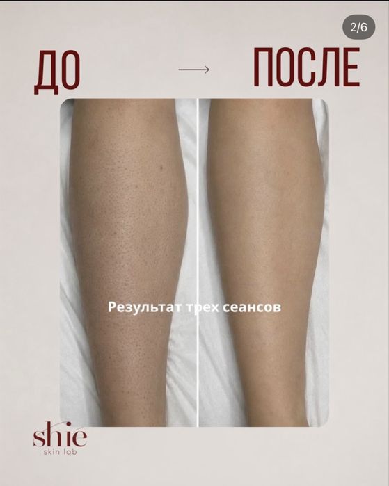 Шугаринг с сахаром комплекс 4000 и лазер