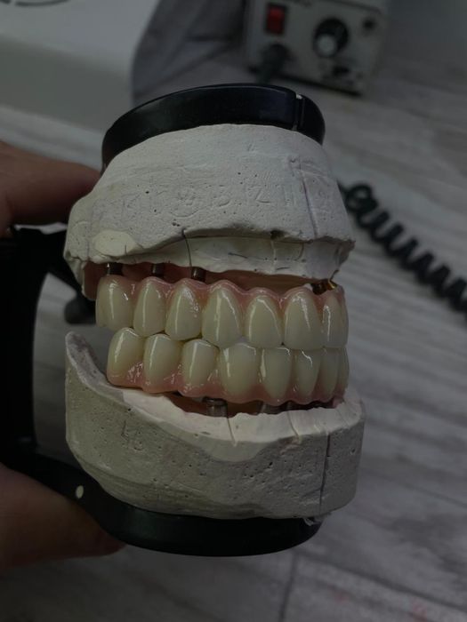 Тіс Протезирование