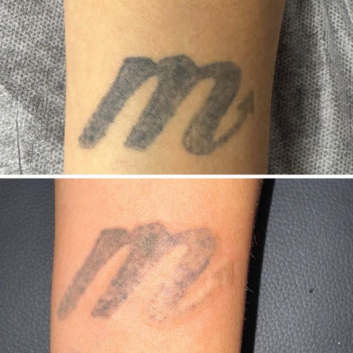 Stergere tatuaje cu laser nd:Yag