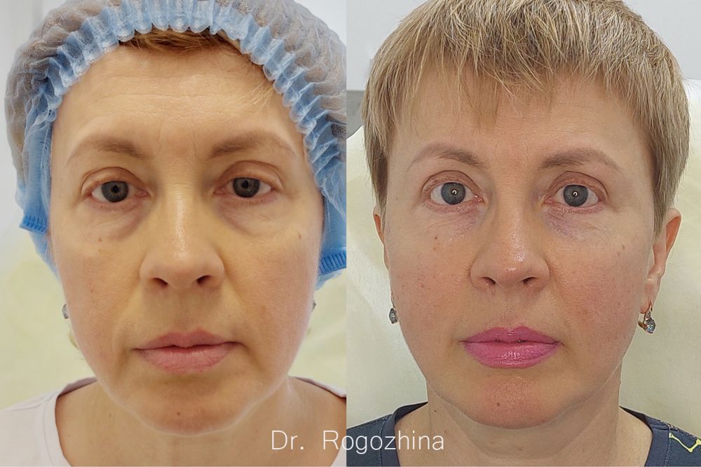 СМАС Лифтинг Ulthera аппарат для Альтера терапии