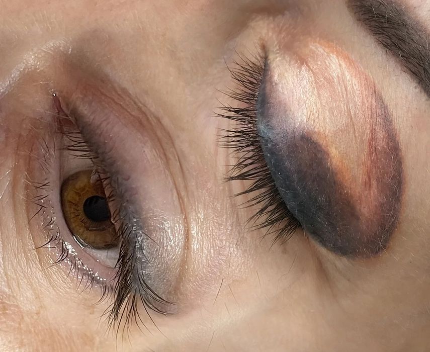 Удаление татуажа ремувером