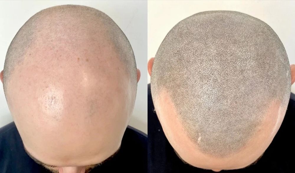 Трихопигментация волос