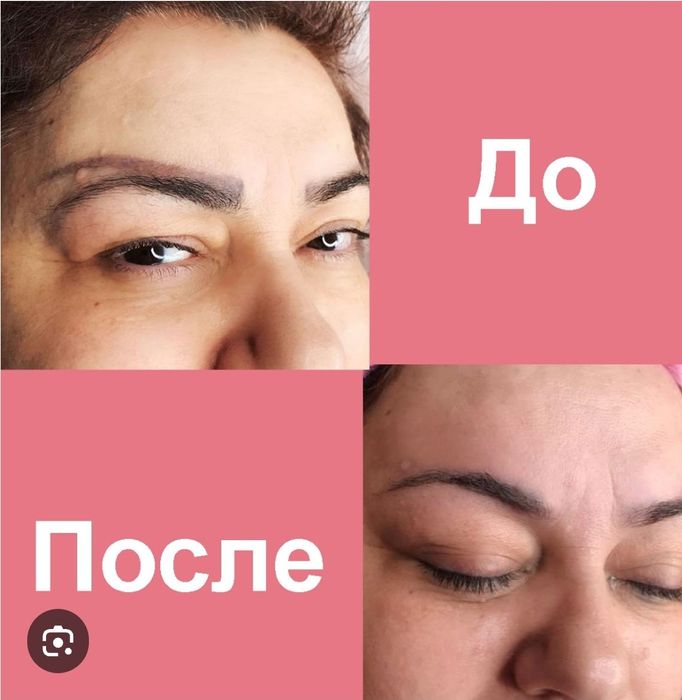 Удаление татуажа бровей.Татуаж учириш.