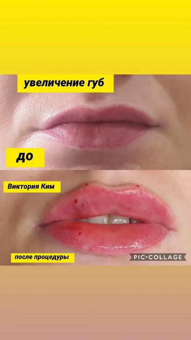 Увеличение губ заполнение носогубки