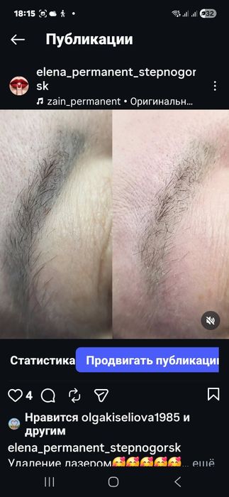 Перманент,лазерное удаление