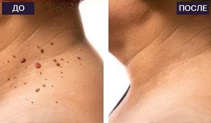 Удаление папиллом. Косметолог.