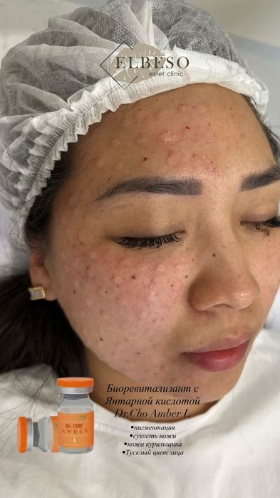 Плазмалифтинг, увеличение губ