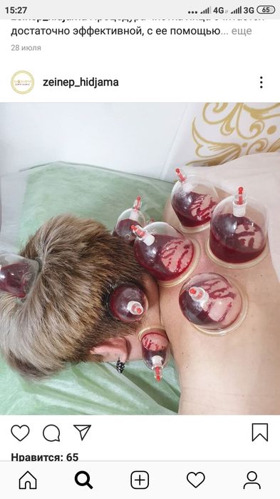 Лечение позвоночника. Мануальная терапия. Хиджама