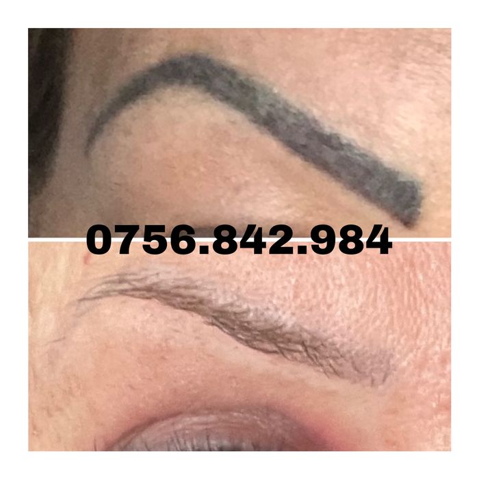 Arad-Eliminare tatuaj cu laser, preturi de la 100 ron