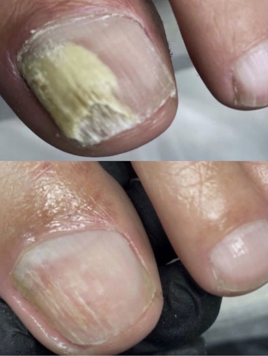 Подолог.Бородавки.Вросший ноготь