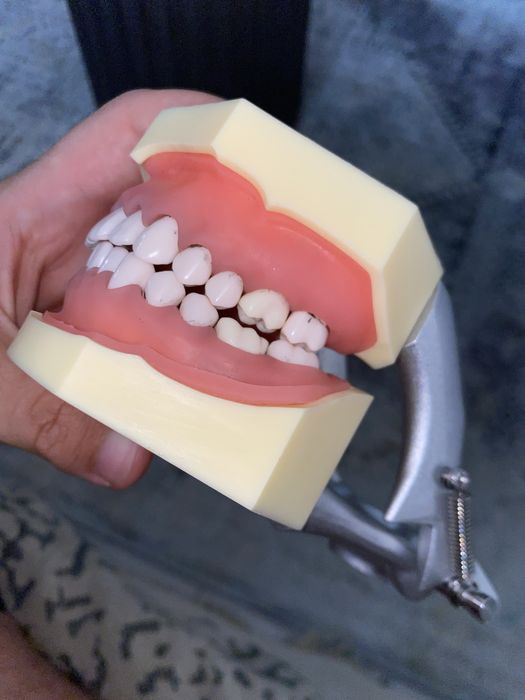 Arcadă dentară cu boală parodontală și tartru