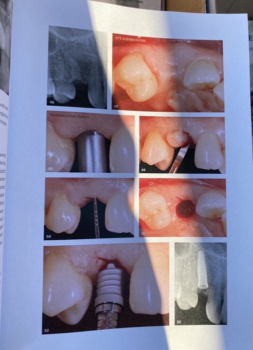 The Single-Tooth Implant J.Chu