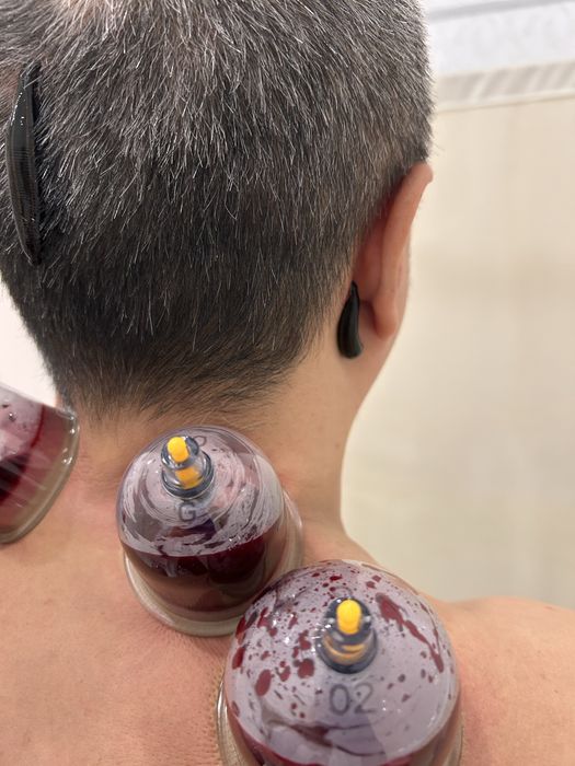 Лечение пиявками Гирудотерапия