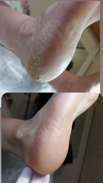 Ичига усган тирнок,Подолог хизмати