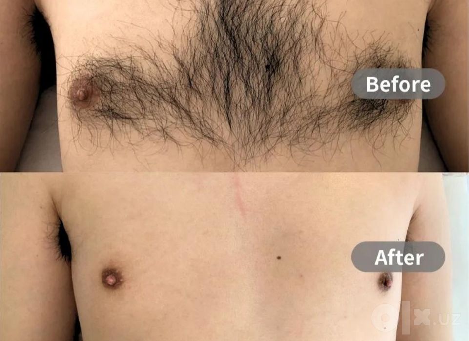 Депиляция для мужчин