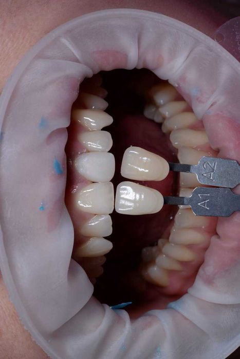 Зуботехническая CAD/CAM Система Для Изготовления Циркониевых Зубов