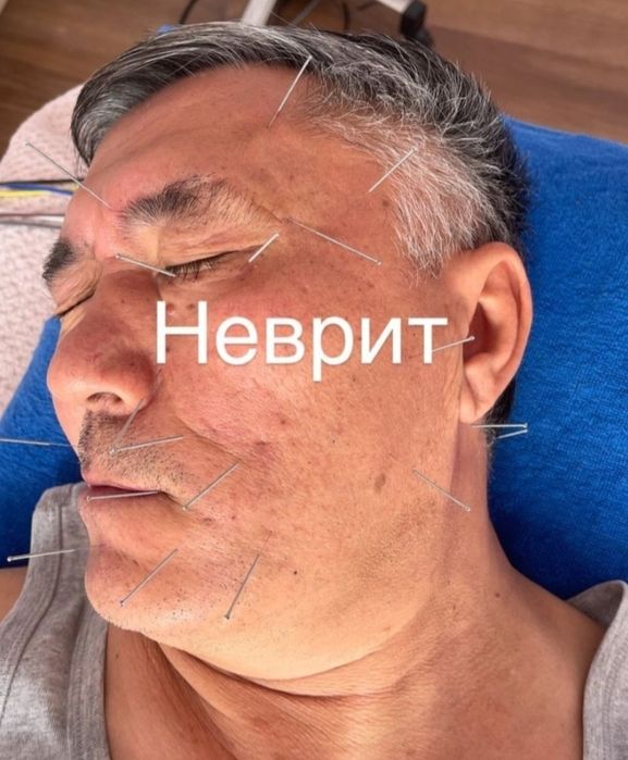 Инетерапиясы, иглоукалывание