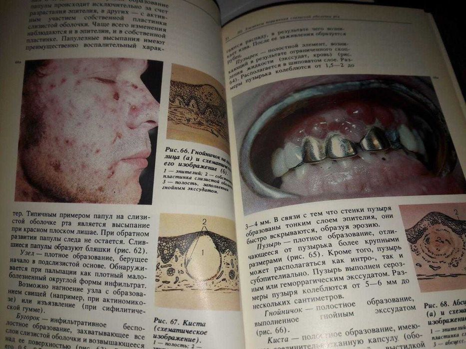 Атлас заболеваний слизистой оболочки рта.