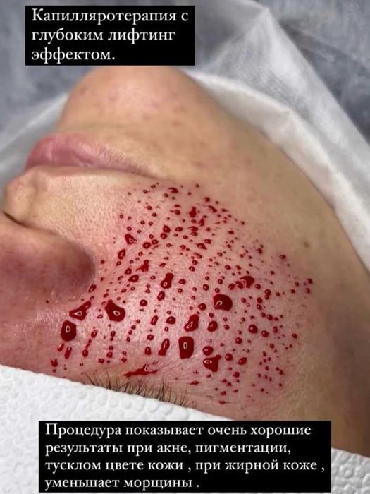 Хиджама лечнбно оздоровление