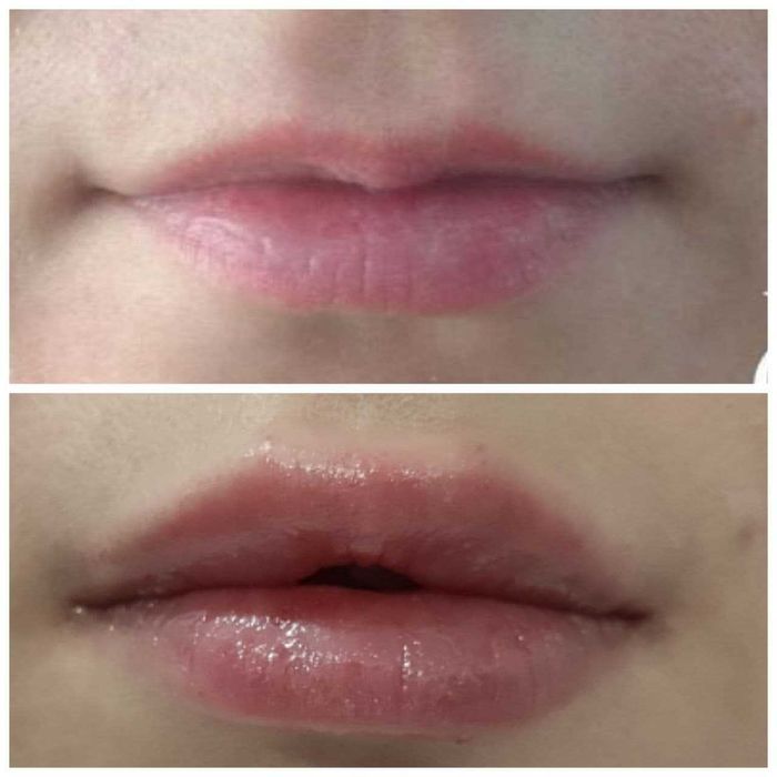 Увеличение губ. Контурная пластика и коррекция губ.
