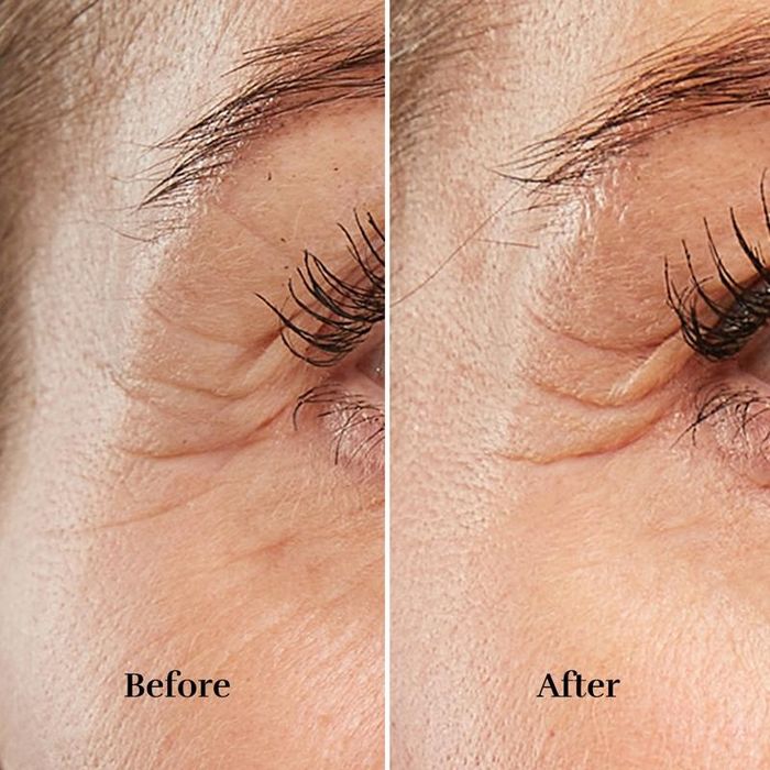 Чисто нов козметичен уред за стягане на кожата Silk'n FaceTite