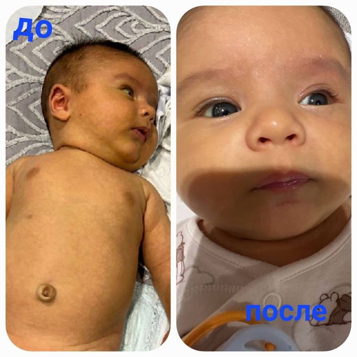 Фотолампа - эффективный метод лечения желтушки у новорожденных