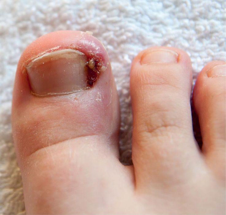 Проблемы с ногами (стопами) и ногтями