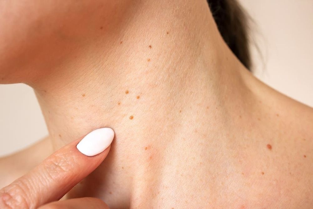 Crema pentru eliminarea papiloamelor