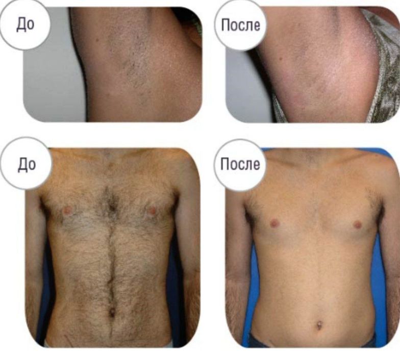Эпиляция депиляция для мужчины и женщины