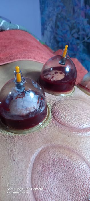 Аль Хиджама Лечебная