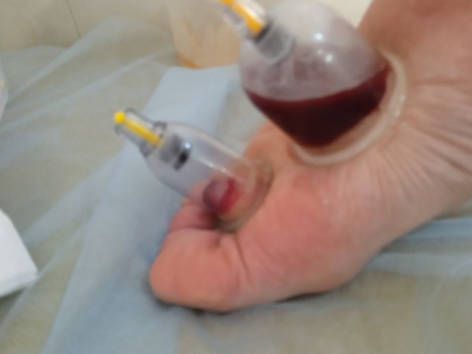 Хиджама ,массаж профессионально.Опыт 10 лет