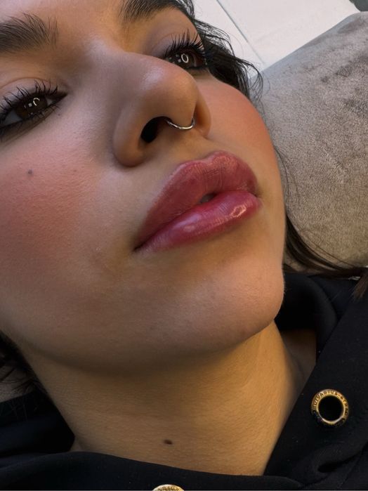 Контурная пластика губ