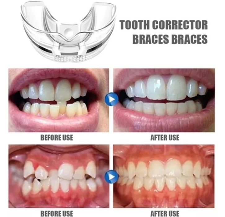 Промо-Ортодонтски коректор,шини,алайнер на зъби брекети зъбен фиксатор