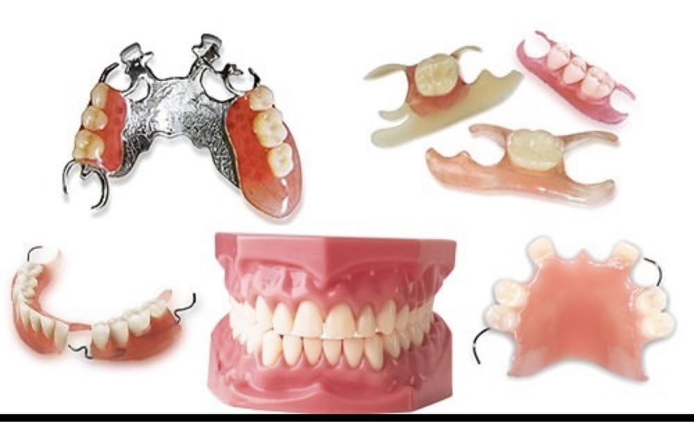 Съемный протез зубов какие бывают. Иммедиат протез бюгельный. Частичный зубной протез. Частичный съемный протез. Съемные протезы на задние зубы.