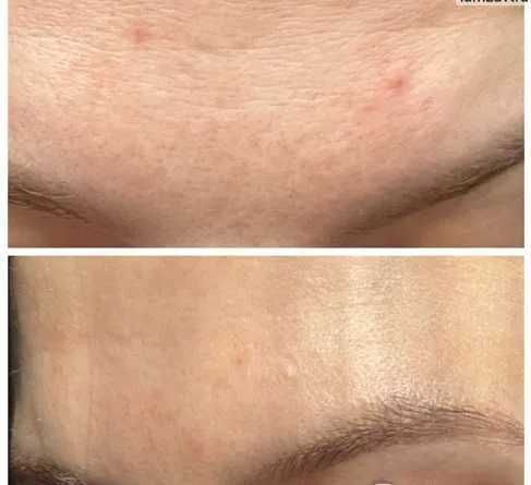 Пиллинг BioRePeel, флакон 6мл (на 5-6 процедур). Италия 100% оригинал!