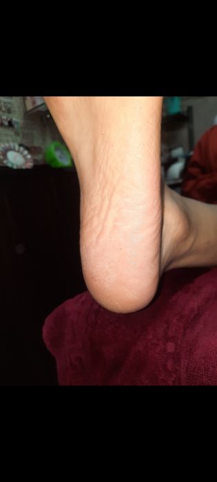 Титановая нить, исправление вросших ногтей.