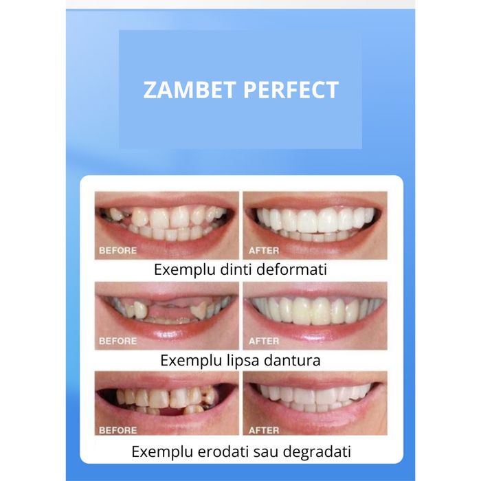 Set fatete dentare, superioare si inferioare, fatete cosmetice cu gel