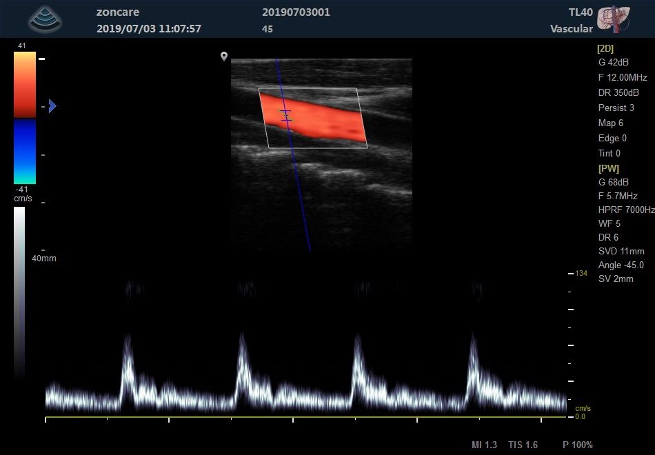 Zoncare-Q3 - Цифровой стационарный УЗИ аппарат с цветным