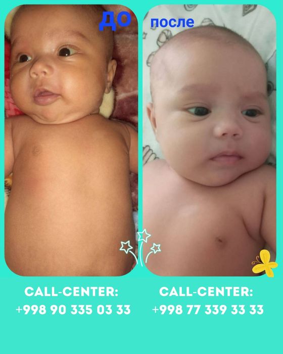 Фотолампа - лечение желтушки у новорожденных